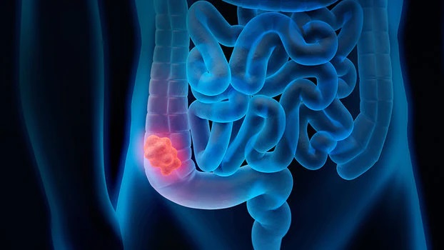 tumore colon kit Cerveteri